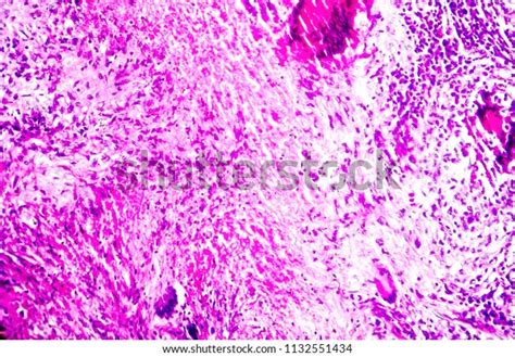 Caseous Necrosis Lymphatic Node Light Micrograph Stock Photo 1132551434