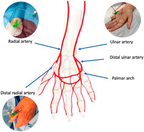 Jcm Free Full Text Radial Artery Access For Percutaneous