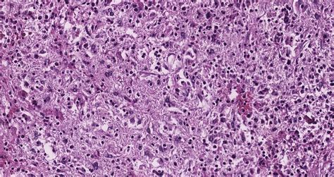 Rosai Dorfman Disease In The Kidney Siba El Hussein Md Medium