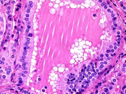 Autoimmune disease leading to hyperthyroidism. Graves disease (pathology) | Image | Radiopaedia.org