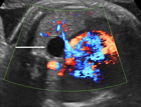 Bronchogenic Cyst Transverse Color Doppler US Image Through The Fetal