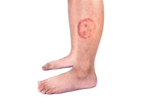 An Overview Of Ringworm