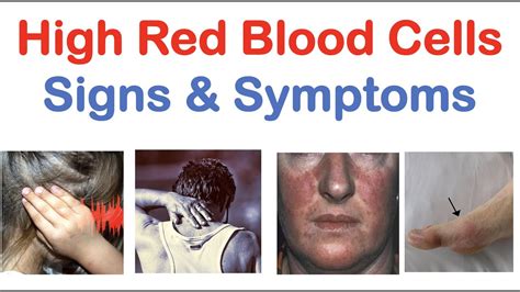High Red Blood Cells Polycythemia Signs And Symptoms And Why They Occur