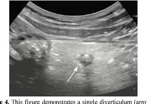 Pdf Ultrasound Diagnosis Of Diverticulitis Semantic Scholar