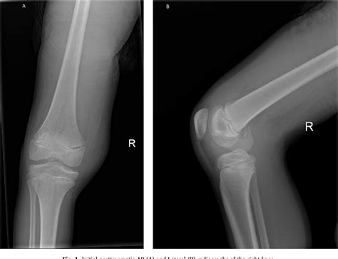 Medial Femoral Condyle Fracture Fixation Images