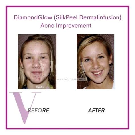 Diamondglow Silkpeel Dermalinfusion Facial Viola Laser And Skin Care