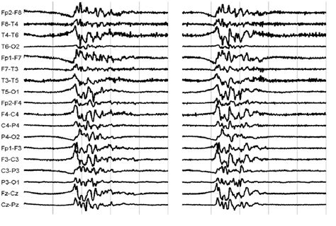 Figure 21 From Investigating Eeg Burst Suppression For Coma Outcome