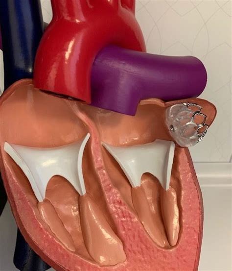 Watchman Procedure | What is a Watchman Device | Dr. Filsoof