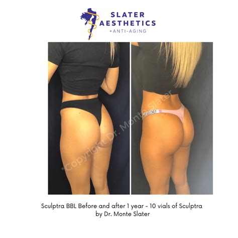 Sculptra Injectable For Long Lasting Results Sculptra Butt Lift