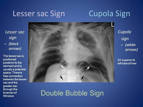 Lesser Sac Sign And Cupola Sign In Pneumoperitoneum Also Football