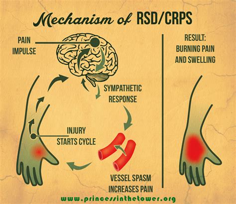 Rsd Pain Chart