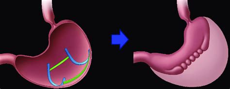 Part Ii Endoscopic Bariatric Procedure Anteroposterior View Gastric