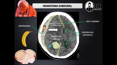 Craniotomia Para Drenagem De Hematoma Subdural