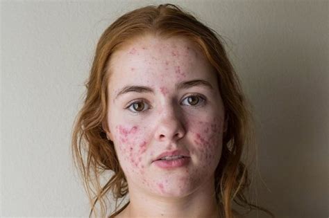 Student With Extreme Acne Reveals Incredible Transformation As Dark Red Spots Clear Up Thanks To