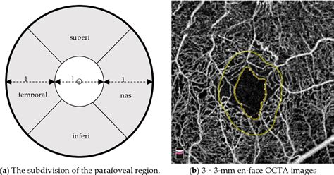 Figure 1 From Retinal Microvascular Changes After Intravitreal