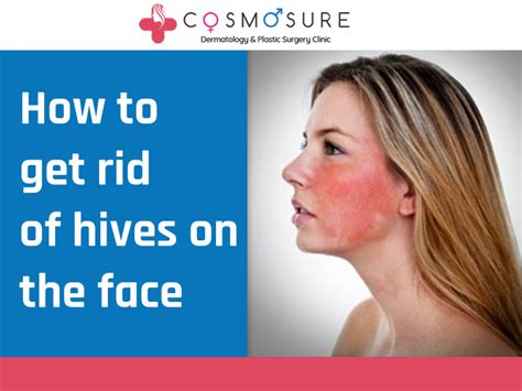 Causes Of Facial Hives Telegraph