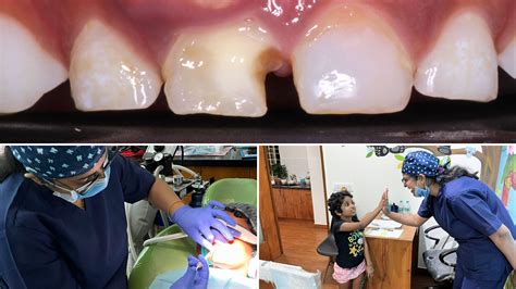 Smile Unleashed: Painless Tooth Extraction with the Magic of Laughing