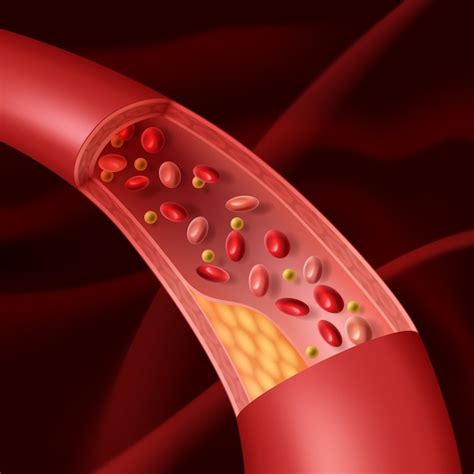 Premium Vector Illustration Of Vascular Atherosclerosis Cutaway View