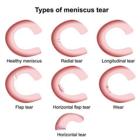 Types Of Meniscal Tears