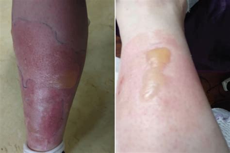 Very often the black widow will not inject any venom into the bite and no serious symptoms develop. Newborn baby found in toilet pipe after student mum gives ...