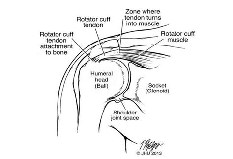 Rotator Cuff Tear Symptoms Treatment 43 Off