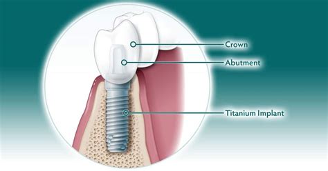 How Do Dental Implants Work What Are Dental Implants Aaoms