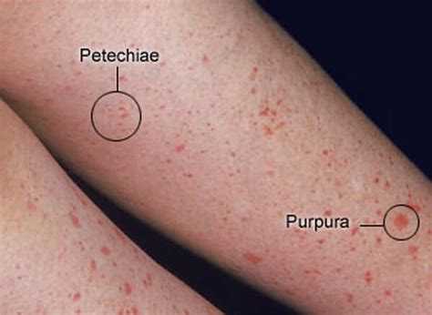 Red Spots On Skin What Causes Them And How To Get Rid Of Them