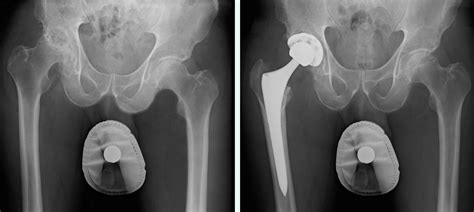 For Active Patients Anterior Hip Replacement Surgery May Shorten
