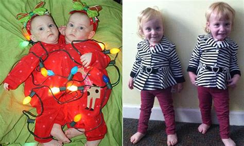 Conjoined Twins 2 Are Thriving A Year After They Were Separated