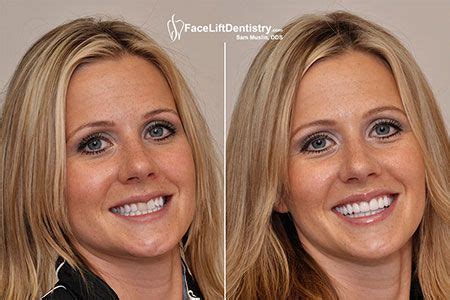 An overbite can be fixed without braces. Advanced Cosmetic Dentistry | No-Surgery Bite Correction ...