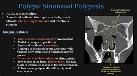 Polyps Nasal Septum Allergic Fungal Sinusitis Nasal Cavity