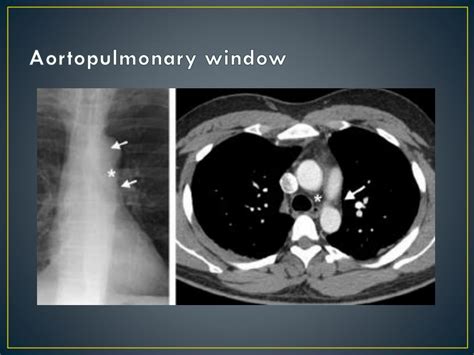 Ppt Imaging Anatomy Of The Mediastinum Powerpoint Presentation Free