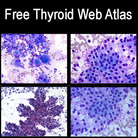 Medical Laboratory And Biomedical Science Free Online Atlas Of Thyroid