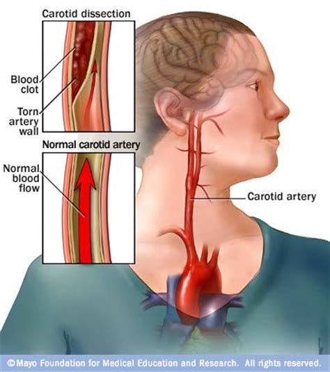 The carotid arteries extend out from the aorta artery, which transports blood out of the heart and is the there are two carotid arteries: Dissection, Carotid Artery - Medical Blog