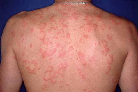 Cetirizine Provides More Benefits For Acute Urticaria Than