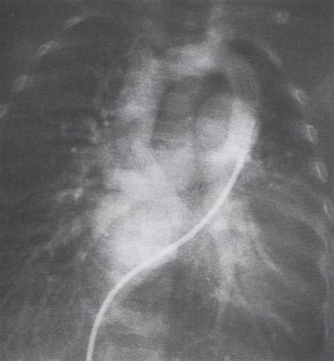 This results in drainage of all pulmonary venous return into the systemic venous circulation. Total Anomalous Pulmonary Venous Return - radRounds ...