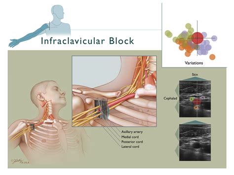 Supraclavicular And Infraclavicular Nerve Blocks Anes
