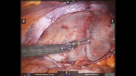 The pores in the mesh allow tissue to grow into the. robotic inguinal hernia repair 1 - YouTube