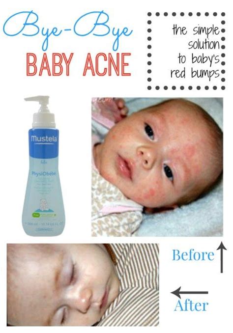Bye Bye Baby Acne The Simple Solution To Babys Red Bumps Sugar Baby