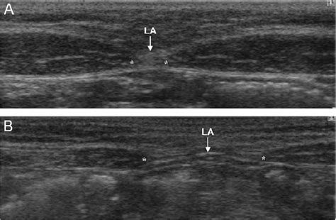 Ultrasound Images Showing The Inter Recti Distance Ird And Linea Alba