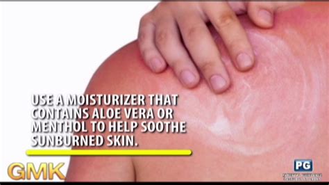 Sunburn Causes Symptoms And Prevention Usapang Pangkalusugan Youtube