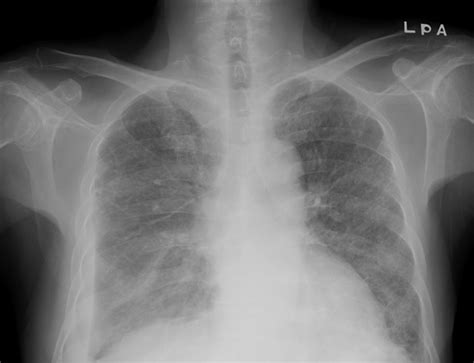 The Chest Radiography The Initial Chest Radiograph Reveals Diffuse