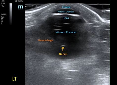 Gaining The Diagnosis Of Vitreous Hemorrhage With Ultrasound Med Tac