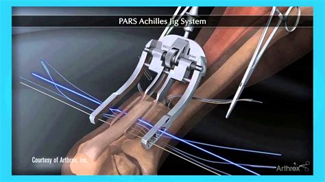 Minimally Invasive Surgery For Achilles Tendon Repair