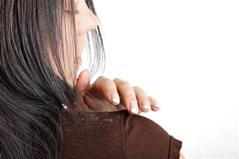 Dandruff Shoulder Stock Photos Pictures And Royalty Free Images Istock