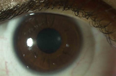 Pupil White Spots Causes Symptoms Treatment Pupil White Spots