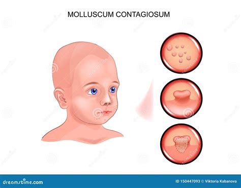 Molluscum Contagiosum In A Child Stock Vector Illustration Of