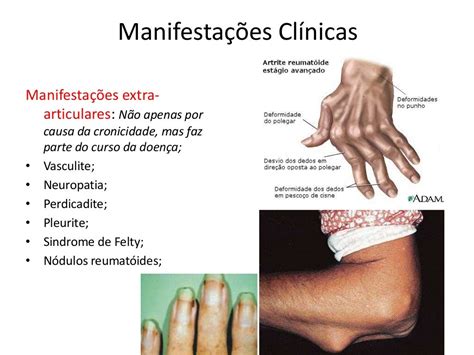 Manifestações Clínicas Artrite Reumatóide