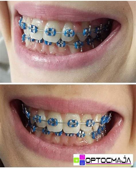 10 Colored Blue Braces For Adults And Kids Braces Explained