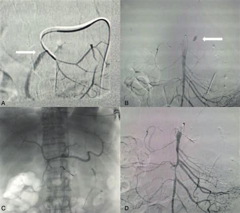 Angiography And Transcatheter Embolization A White Arrow Shows